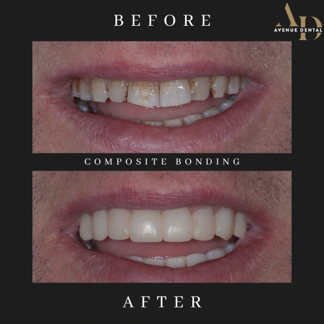composite bonding before and after photo taken at avenue dental practice in Leamington Spa
