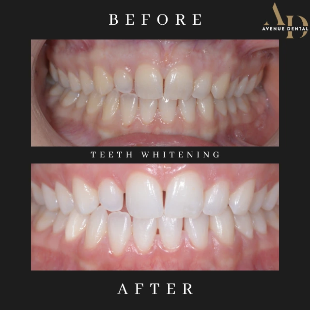 teeth whitening treatment before and after photo taken at avenue dental practice in leamington spa