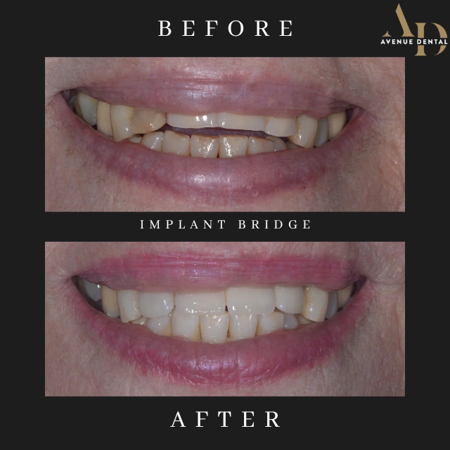 dental implants before and after photo taken at avenue dental practice in Leamington Spa