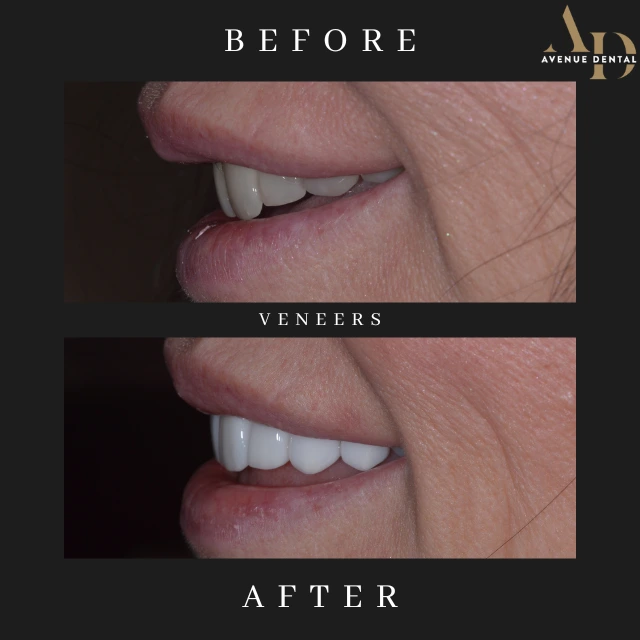 veneers before and after photo taken at avenue dental