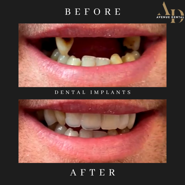 dental implants before and after results photo taken at avenue dental practice