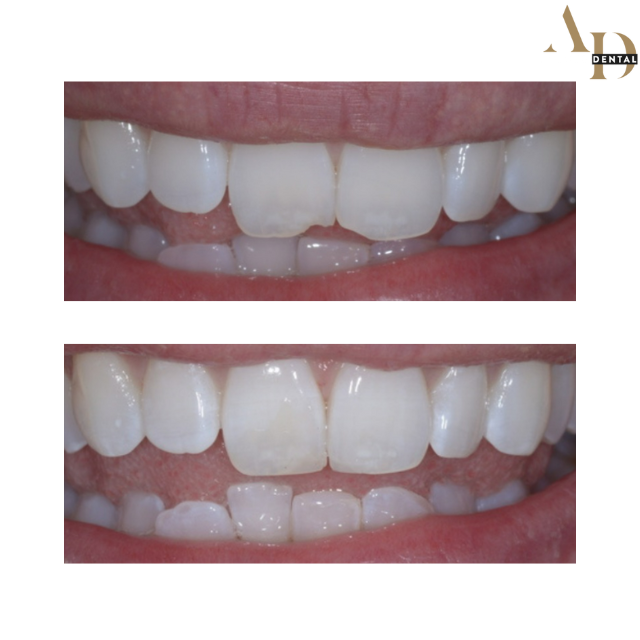 composite bonding photo taken before and after treatment