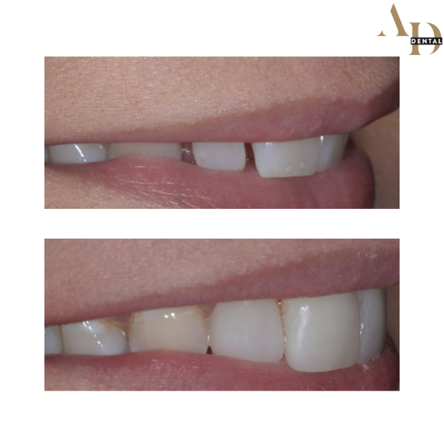 composite bonding photo taken before and after