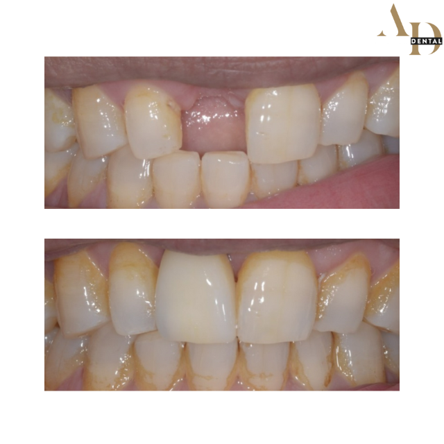 dental implant photo before and after