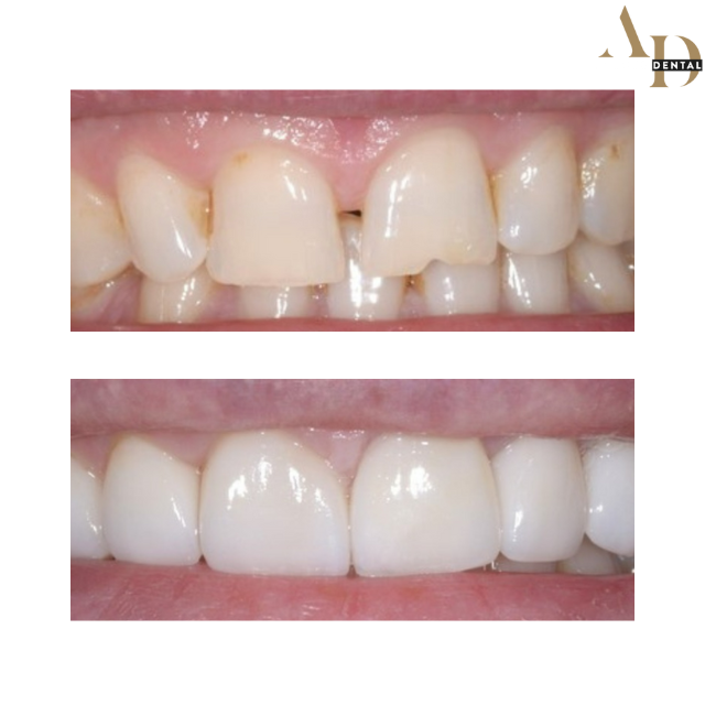 https://avenuedentalpractice.co.uk/wp-content/uploads/2024/04/smile-makeover-photo-before-and-after.png