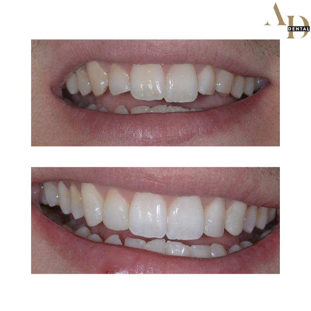 https://avenuedentalpractice.co.uk/wp-content/uploads/2024/07/before-and-after-clear-aligners-Leamington-Spa.png