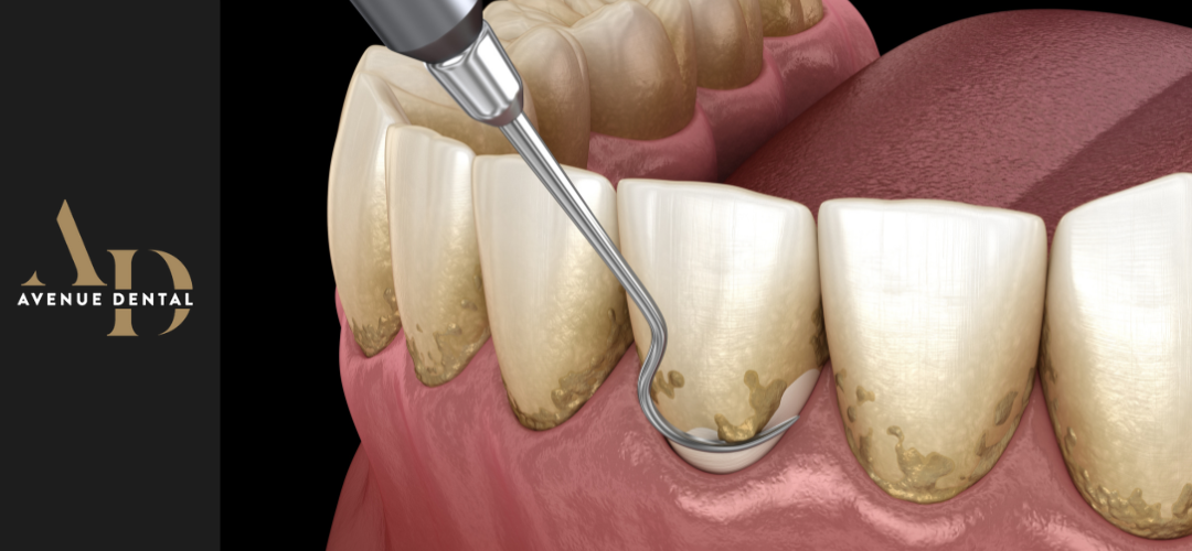 dental scaling