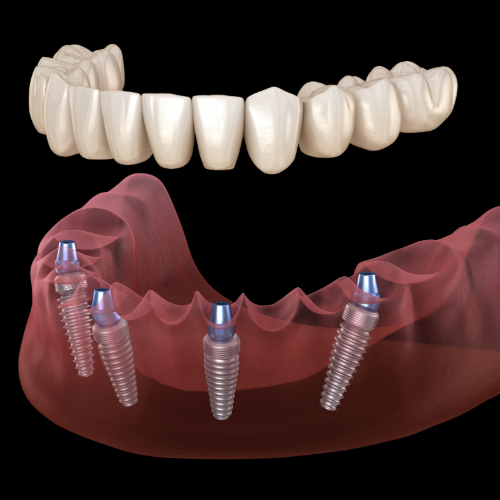 https://avenuedentalpractice.co.uk/wp-content/uploads/2024/12/all-on-4-dental-imlpants-example.png