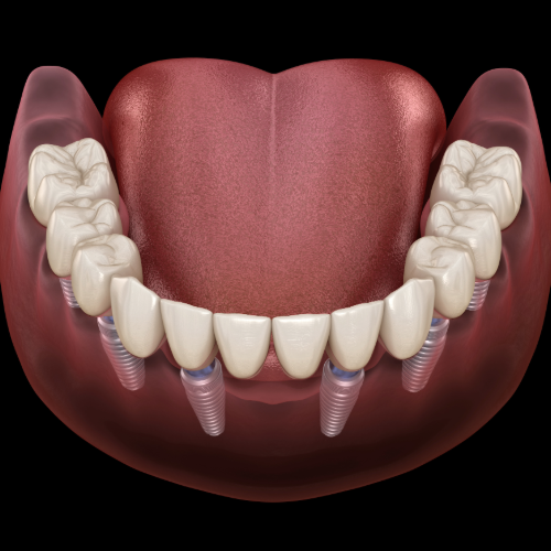 https://avenuedentalpractice.co.uk/wp-content/uploads/2024/12/all-on-6-dental-implants-example.png