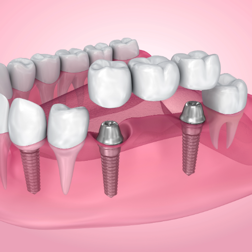 implant-based denture example