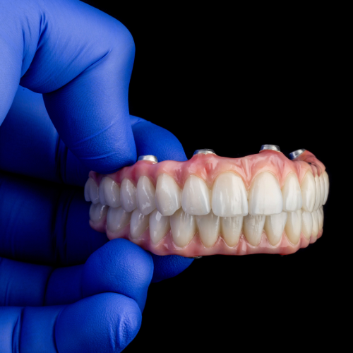 implant-retained denture example