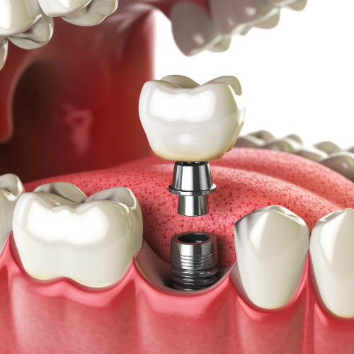 single tooth implants example