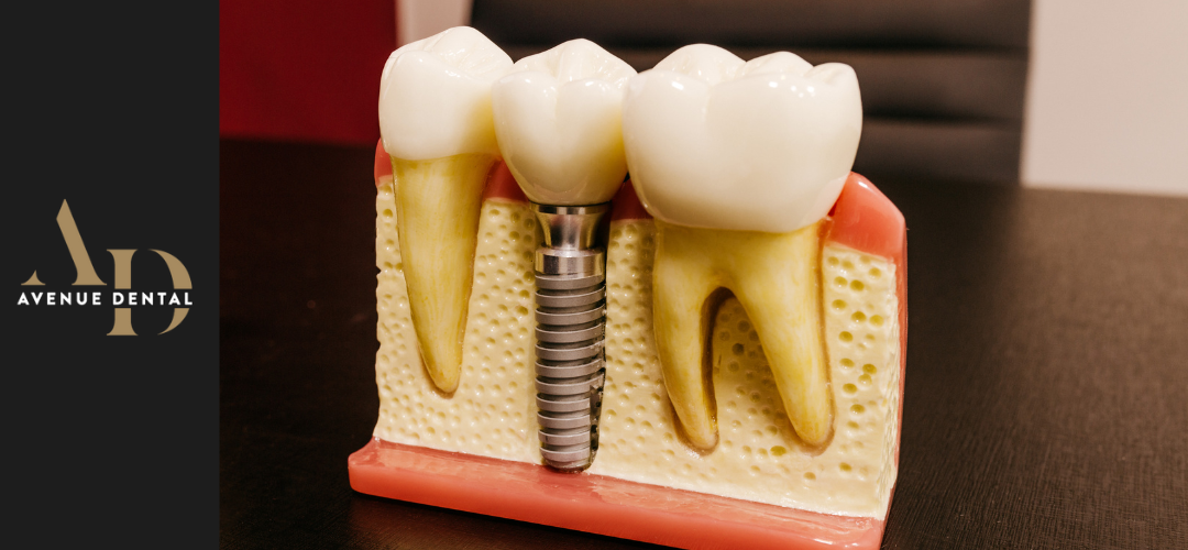 types of dental implants blog