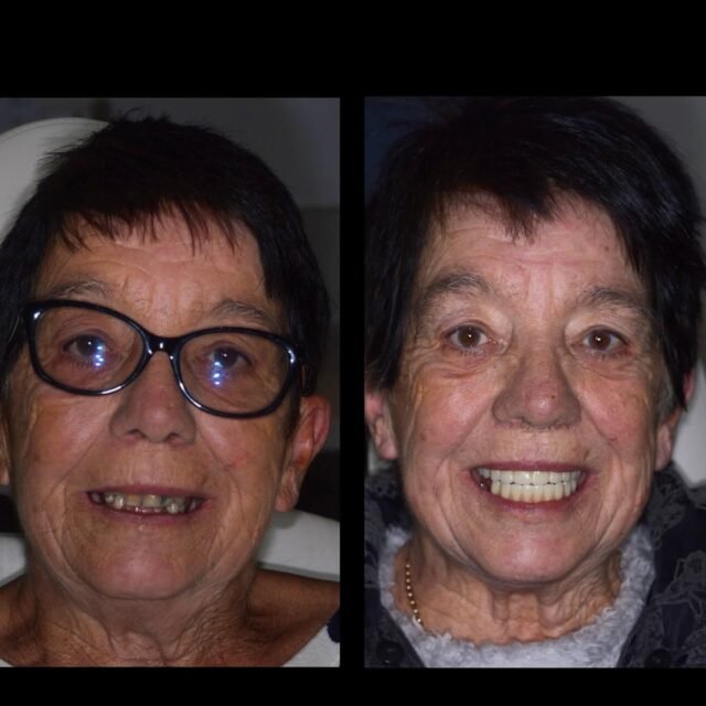 complete mouth dental implants https://avenuedentalpractice.co.uk/wp-content/uploads/2025/07/complete-mouth-dental-implants-640x640.jpg