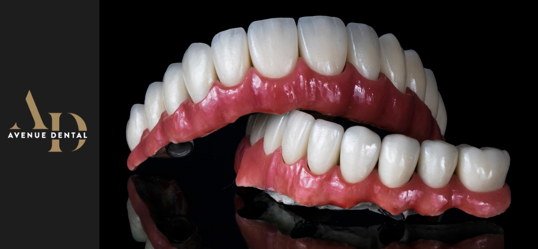 complete mouth dental implants https://avenuedentalpractice.co.uk/wp-content/uploads/2025/07/complete-mouth-dental-implants.png