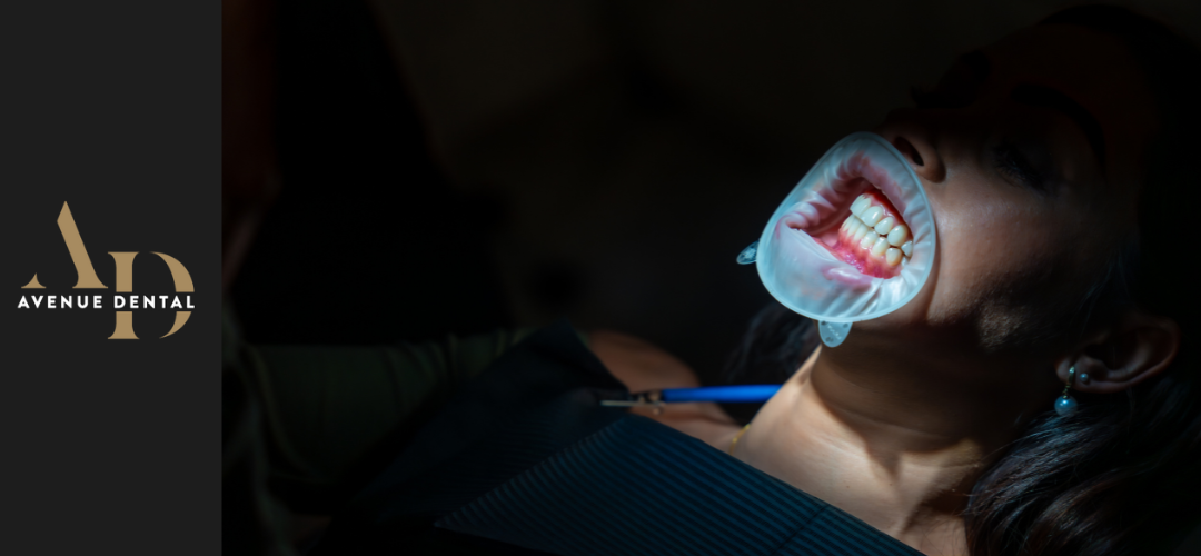 bonding vs whitening https://avenuedentalpractice.co.uk/wp-content/uploads/2025/09/bonding-vs-whitening.png