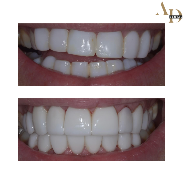 Composite bonding before and after — patient 2, small gaps closed, Avenue Dental Leamington Spa