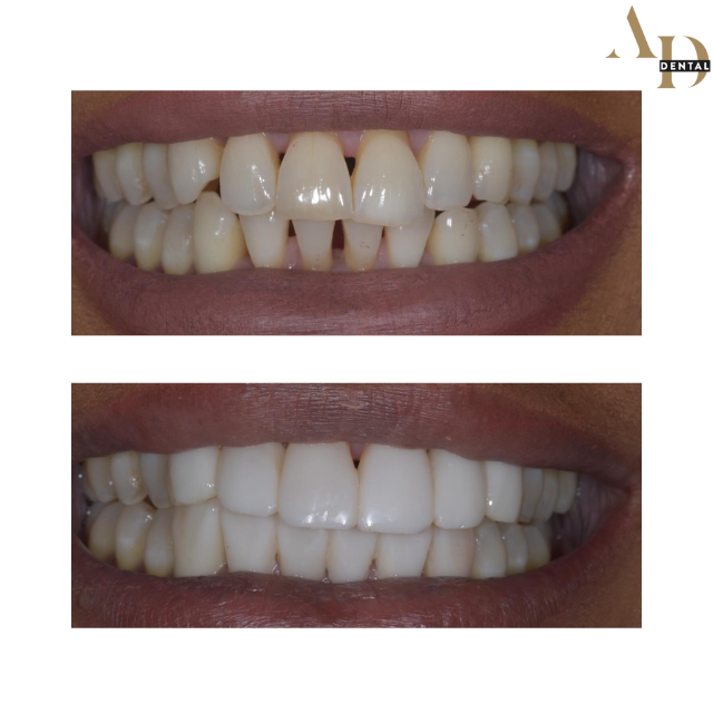 Composite bonding before and after — patient 3, chipped tooth repaired, Avenue Dental Leamington Spa
