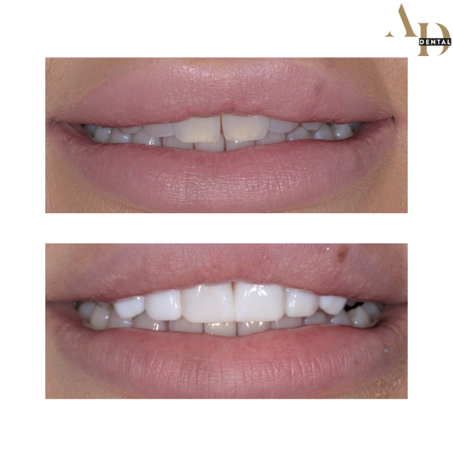Composite bonding before and after — patient 4, uneven edges reshaped, Avenue Dental Leamington Spa