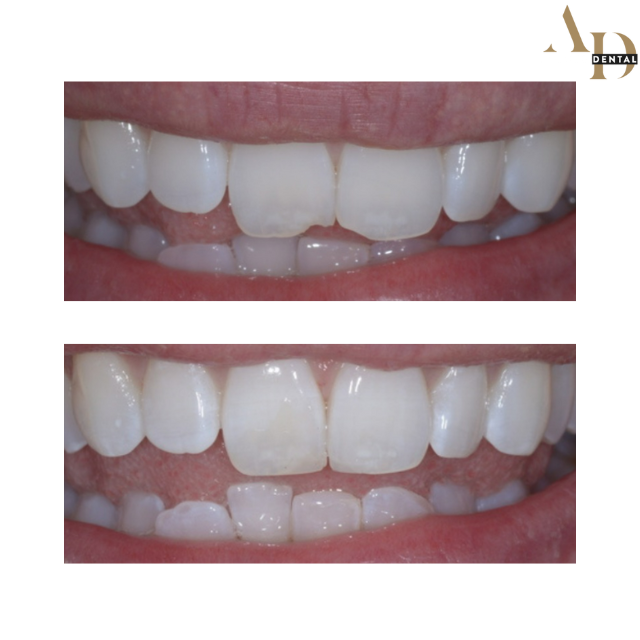 Composite bonding before and after — patient 1, chipped edges restored, Avenue Dental Leamington Spa