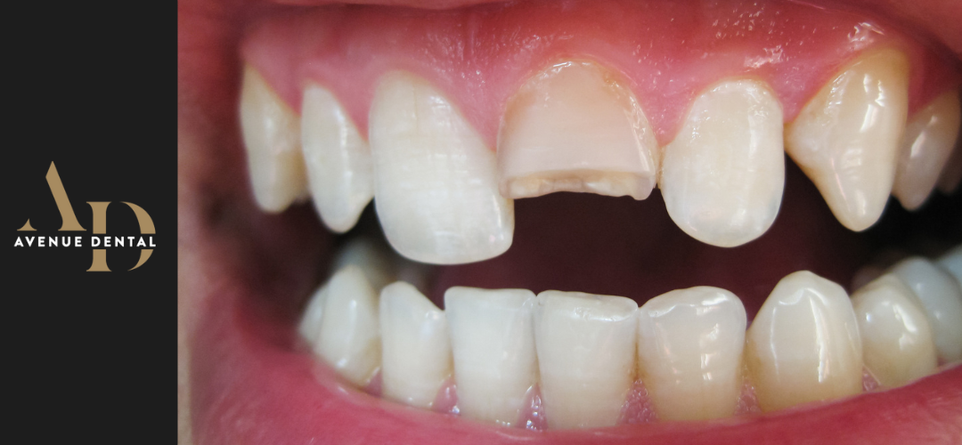 https://avenuedentalpractice.co.uk/wp-content/uploads/2025/10/broken-tooth-dentist-advice.png