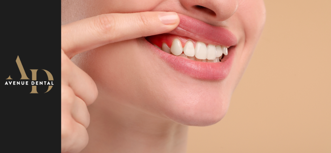 dental abscess - symptoms and treatment https://avenuedentalpractice.co.uk/wp-content/uploads/2025/11/dental-abscess-symptoms-and-treatment.png