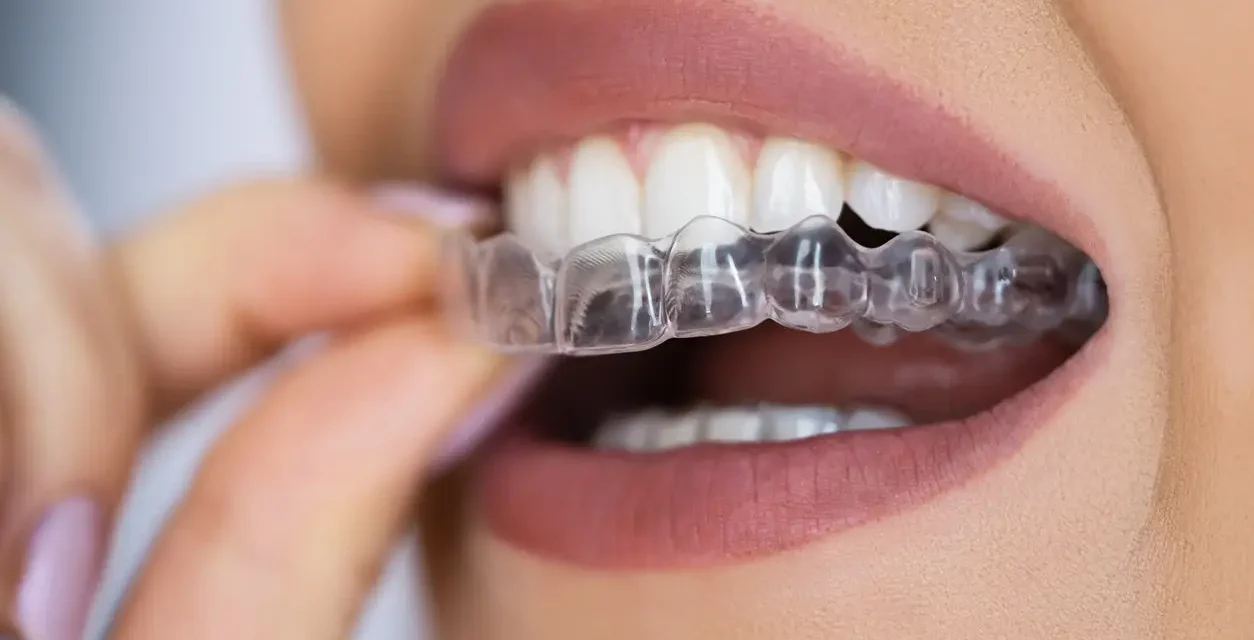 How Much Is Invisalign in the UK
